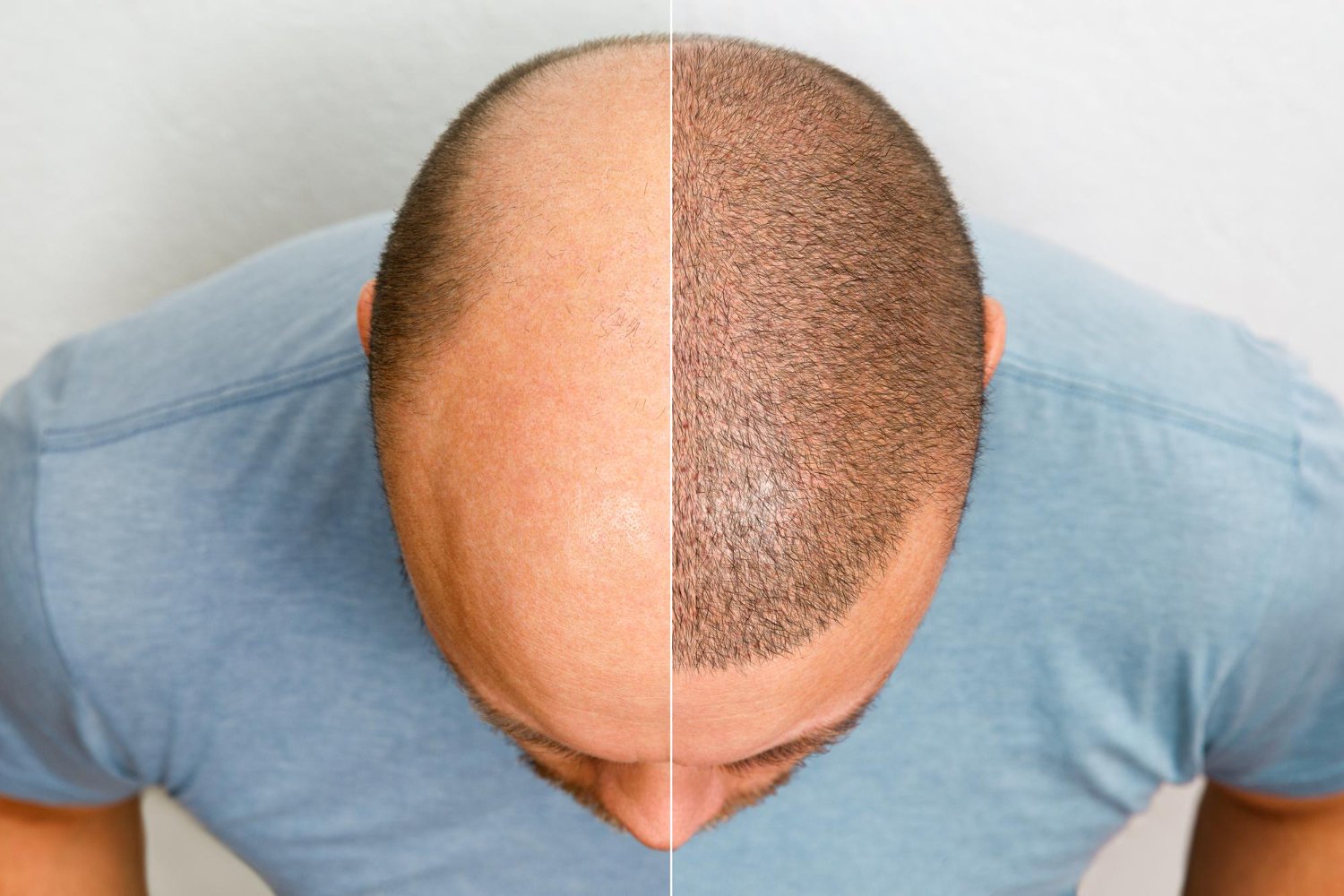 HAIR & BEARD TRANSPLANT