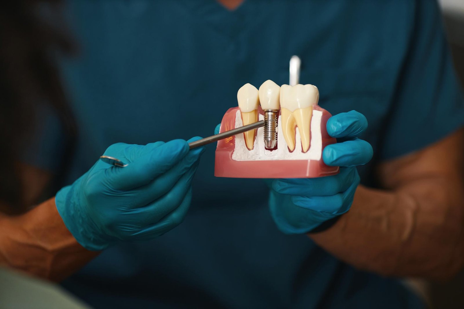 DENTAL IMPLANTS